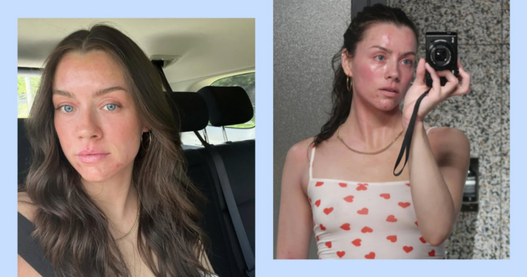 Skinfluencer Madeleine Edwards Doesn’t Let Eczema Flare-Ups Run Her Life
